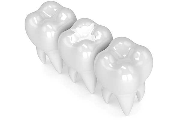 Composite Fillings | SW Calgary Dentist | Marda Loop | Odeon Dental