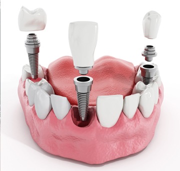 Dental Implants | SW Calgary Dentist | Marda Loop | Odeon Dental