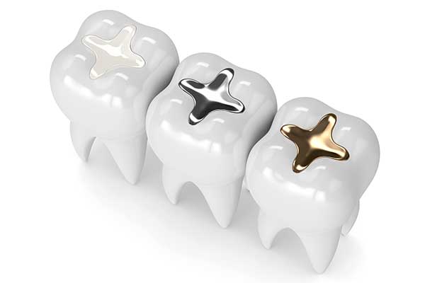 Filling Types | SW Calgary Dentist | Marda Loop | Odeon Dental