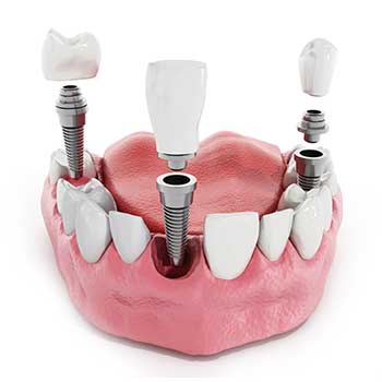 Dental Implants | SW Calgary Dentist | Marda Loop | Odeon Dental