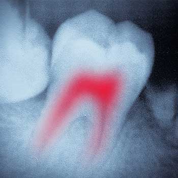 Root Canal Therapy | SW Calgary Dentist | Marda Loop | Odeon Dental