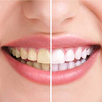 Teeth Whitening | SW Calgary Dentist | Marda Loop | Odeon Dental