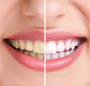 Teeth Whitening | SW Calgary Dentist | Marda Loop | Odeon Dental