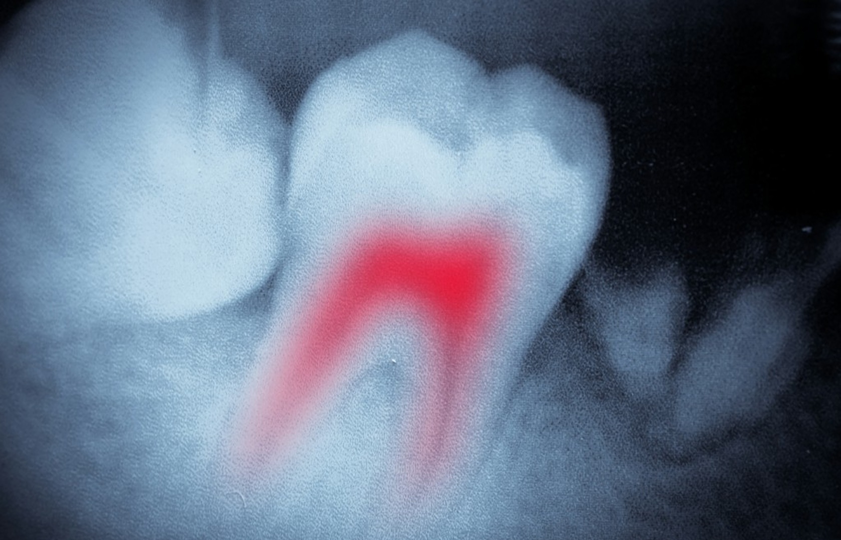 Root-Canal-Tooth-Oedon-Dentistry